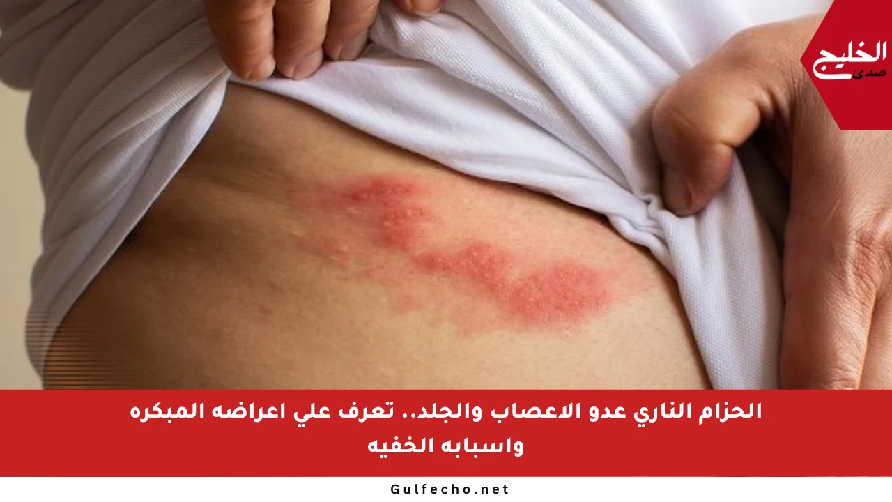 الحزام الناري عدو الأعصاب والجلد.. تعرف على أعراضه المبكرة وأسبابه الخفية